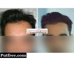 Myths You Need to Avoid About Hair Transplant
