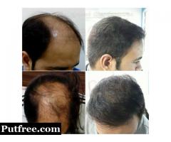 What are the Most Popular Techniques of Hair Transplant in Chennai?