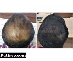 All About the Hair Transplant in Dermatology