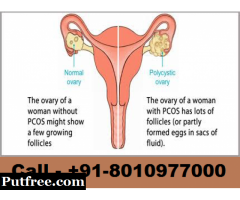 Best ayurvedic Pcos/Pcod treatment in Sarita Vihar - Phone - 8010977000